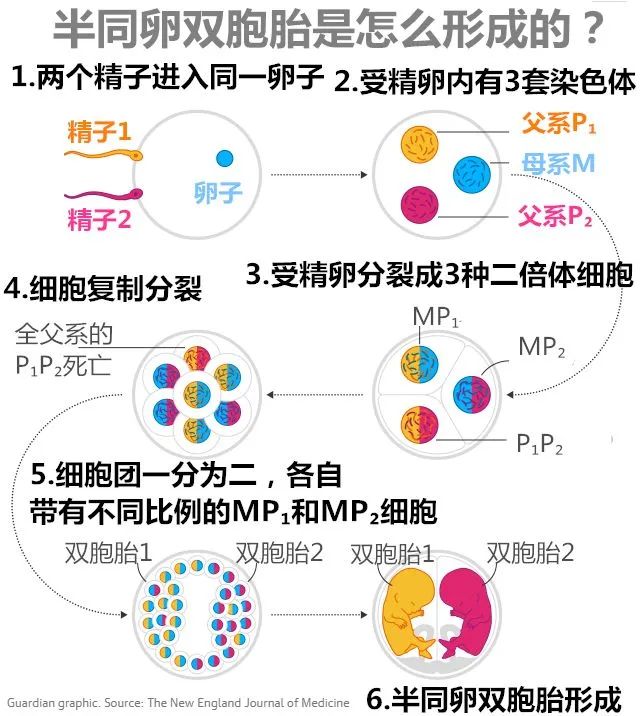 什么是“半同卵双胞胎”?全世界仅有两例被确认